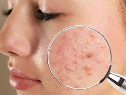 एक्ने और पिंपल्स से निज़ात: सैलिसिलिक एसिड सीरम से पाएं साफ और स्मूद त्वचा 2 image 188 1