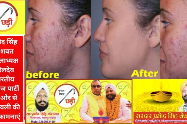 एक्ने और पिंपल्स से निज़ात: सैलिसिलिक एसिड सीरम से पाएं साफ और स्मूद त्वचा