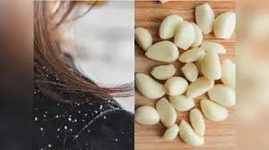 LiceTreatment : सिर की जूं से छुटकारा पाने के 3 असरदार घरेलू नुस्खे, योग गुरु ने बताए आसान उपाय 4 image 11 3