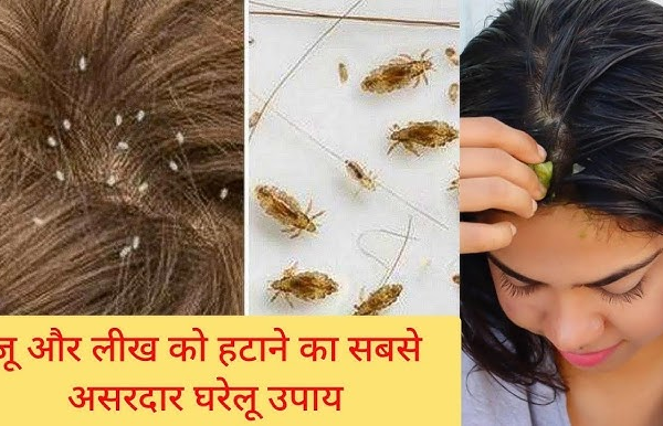 सिर की जूं से छुटकारा पाने के 3 असरदार घरेलू नुस्खे, योग गुरु हंसाजी योगेन्द्र ने बताए आसान उपाय