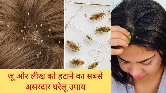 सिर की जूं से छुटकारा पाने के 3 असरदार घरेलू नुस्खे, योग गुरु हंसाजी योगेन्द्र ने बताए आसान उपाय